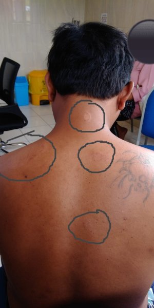Kusta Merupakan Penyakit Menular Yang Tidak Mudah Menular